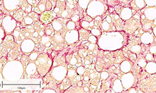 Fibrotic_liver_section_220x132px.jpg